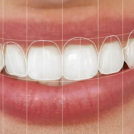 smile designing