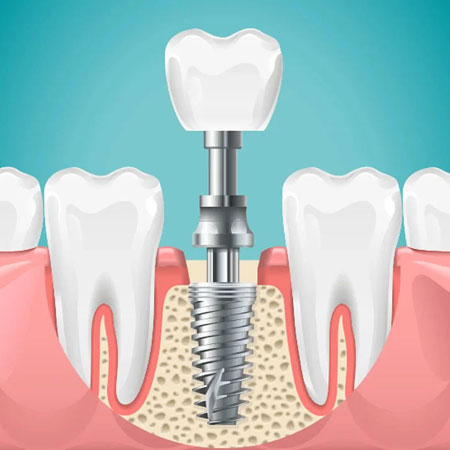 dental implants