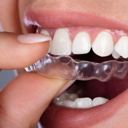braces