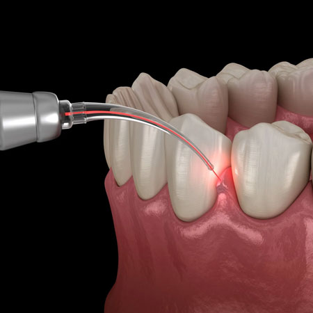 extractions impactions