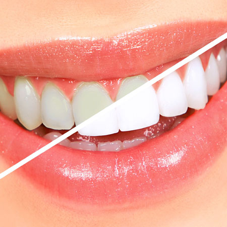 teeth whitening