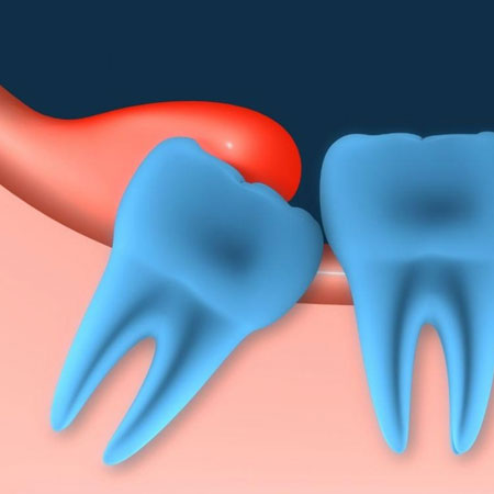 aligners